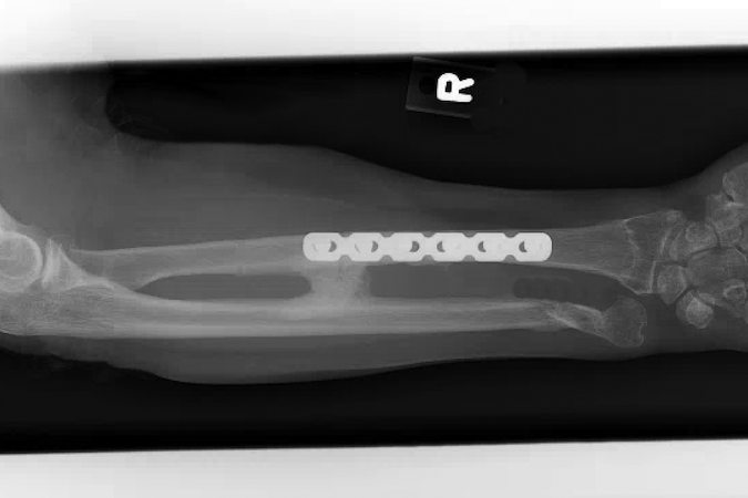 Fracture Radius Andor Ulna Andor Both Forearm Bones Hand Surgery Resource 7203
